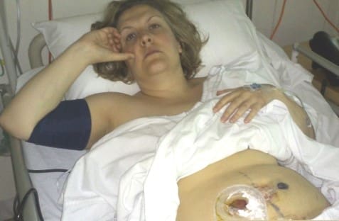 ileostomy bag birth trauma