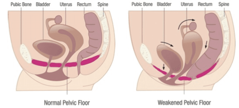 Pelvic Floor Muscle Damage Birth Trauma